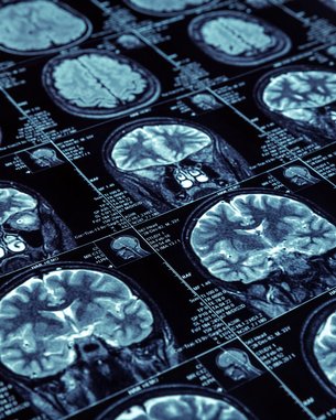 Eine Sammlung von MRT-Scans des menschlichen Gehirns, die verschiedene Ansichten und Schnitte zeigen.